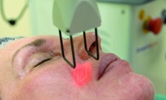 អនុវត្តនីតិវិធី rejuvenation ឡាស៊ែរប្រភាគ